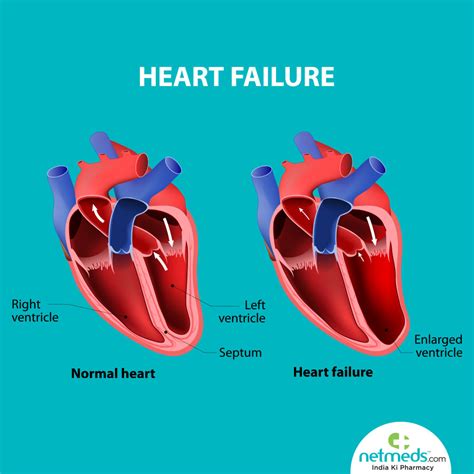 what is severe lv dysfunction.